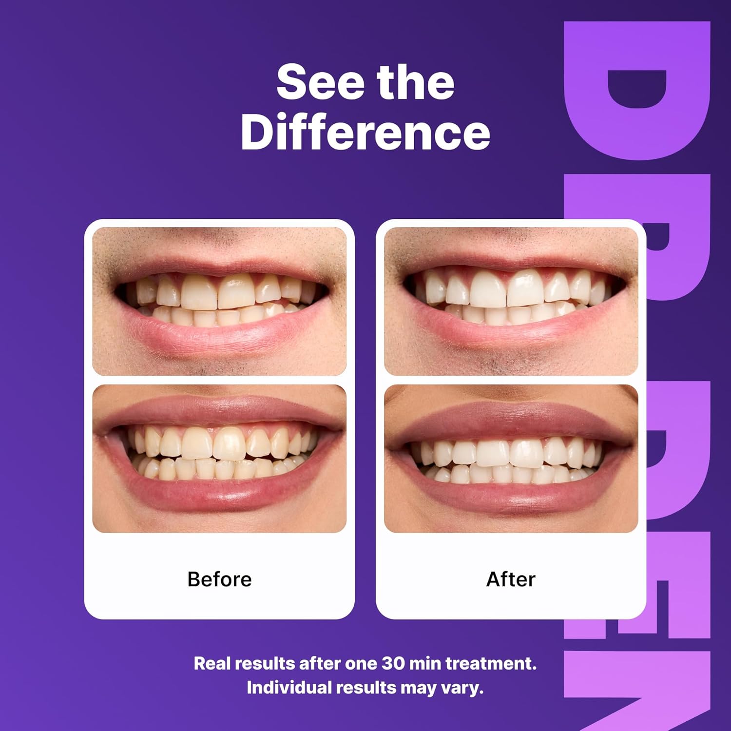 DRDENT Purple Teeth Whitening Strips 21 Treatments - Safe for Enamel - Non Sensitive Teeth Whitening - Whitening Without Any Harm - Pack of 42 Strips + Mouth Opener Included